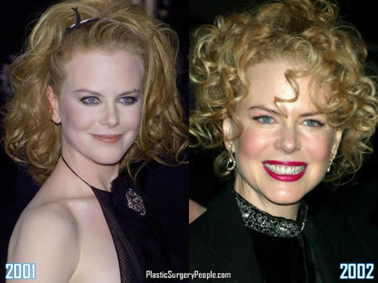 Did Nicole Kidman Have Facelift & Lip Augmentation?