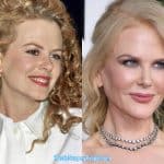 Nicole Kidman Before & After Plastic Surgery