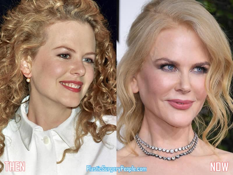 Did Nicole Kidman Have Facelift & Lip Augmentation?