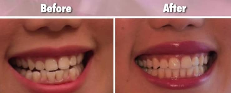 Xiaxue Teeth Straightening
