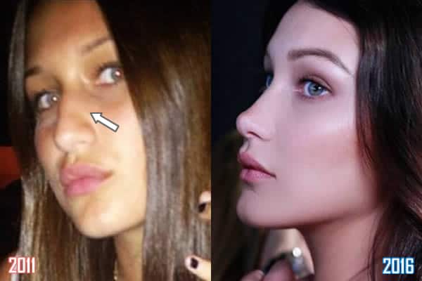 Nose Bridge Hump - Before & After.