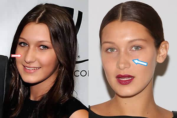 Bella's nose before and after plastic surgery?