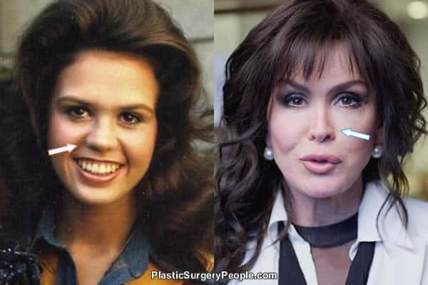 free marie osmond plastic surgery