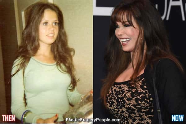 This could be proof that Marie Osmond did not have breast augmentation