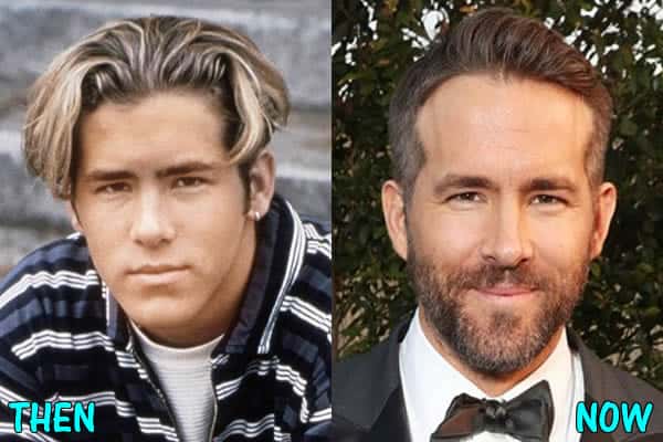Ryan's Nose Before and After