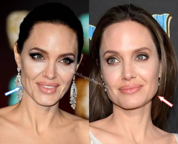 Is Plastic Surgery Angelina Jolie S Beauty Secret Is Plastic Surgery Angelina Jolie S Beauty Secret