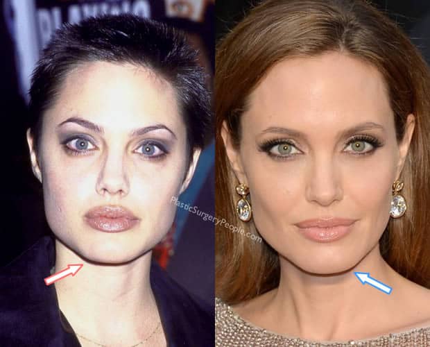Is 'Plastic Surgery' Angelina Jolie's Beauty Secret?