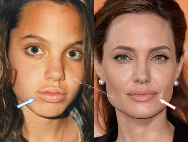 Is 'Plastic Surgery' Angelina Jolie's Beauty Secret?