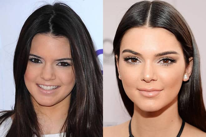 Kendall Jenner lips before and after