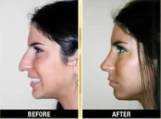 Jen Selter Nose Job Before & After - Side View