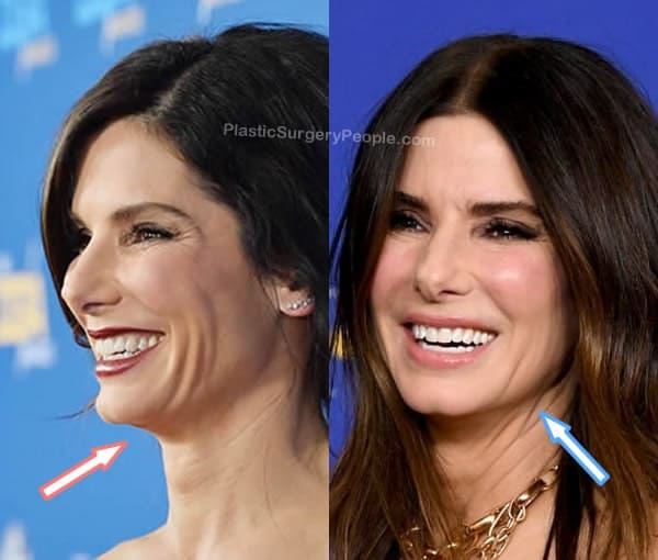 Did Sandra Bullock Have Plastic Surgery Before And After 2021