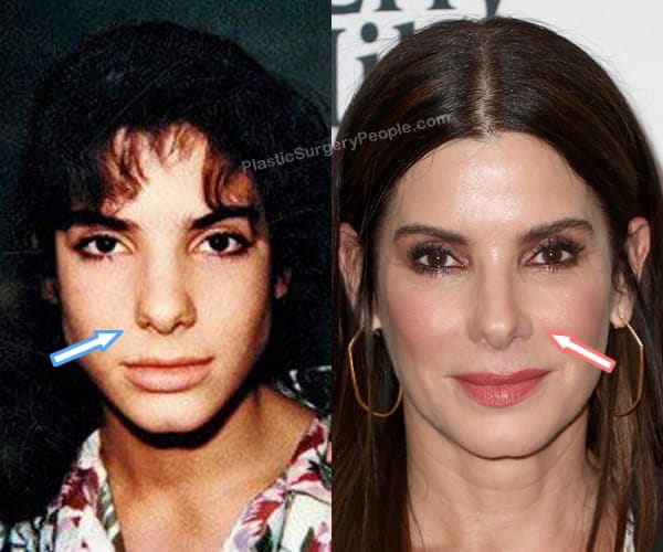 Did Sandra Bullock Have Plastic Surgery Before And After 2021