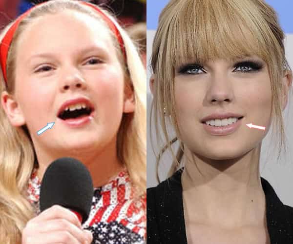 taylor swift before and after veneers