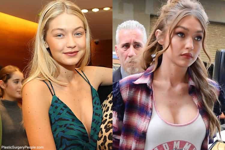 Does Gigi Have Breast Implants?