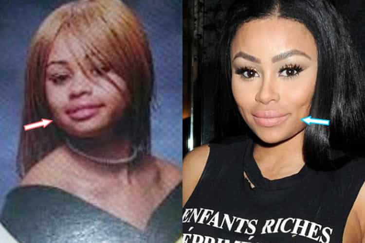 Blac Chyna lip injections before and after photo.