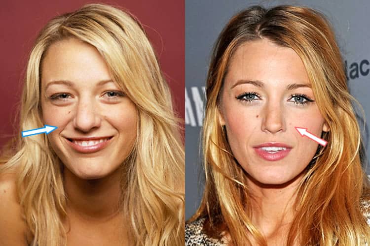 Did Blake Lively get a nose job? 