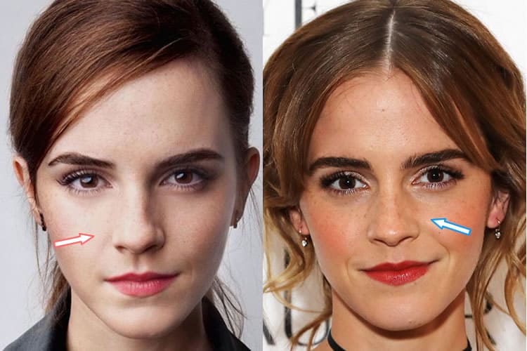 Has Emma Watson Had a Nose Job? 