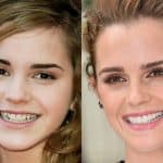 Emma Watson's Teeth Before and After