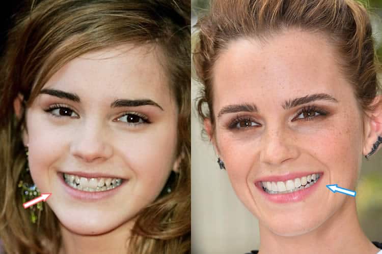 Emma Watson Nose Job