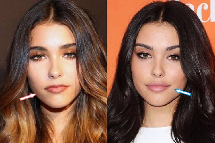 Madison Beer's lips before and after