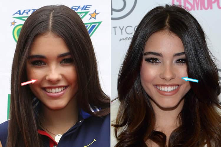 Has Madison Beer had a nose job?