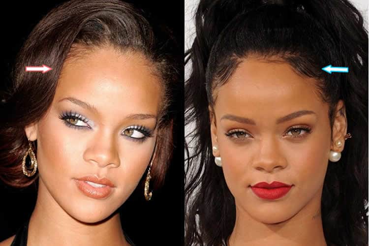 Has Rihanna Had Plastic Surgery? (Before & After Photos 2021)