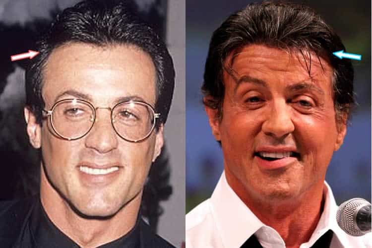 Sylvester Stallone Plastic Surgery Hair, Facelift, Botox, Nose Job?