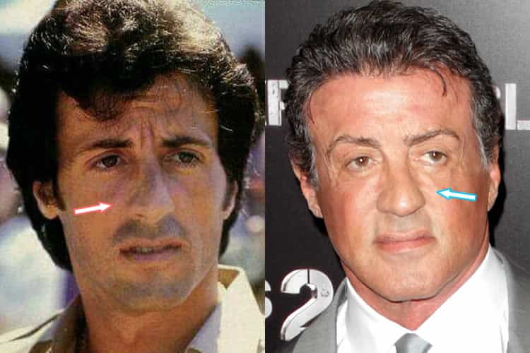 Sylvester Stallone Plastic Surgery Hair, Facelift, Botox, Nose Job?