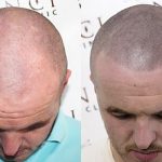 Bald Hair Tattoo Before and After