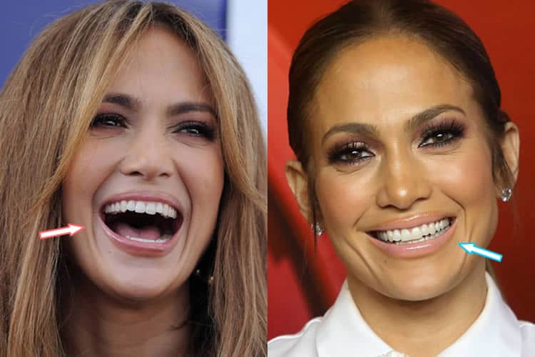 teeth lopez jennifer smile surgery plastic yahoo had nose job celebrities maybe perfect jenifer possible