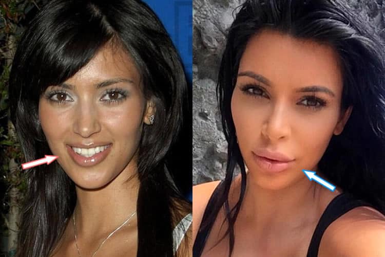 Kim Kardashian Plastic Surgery REVEALED! (Before & After Pics 2018)