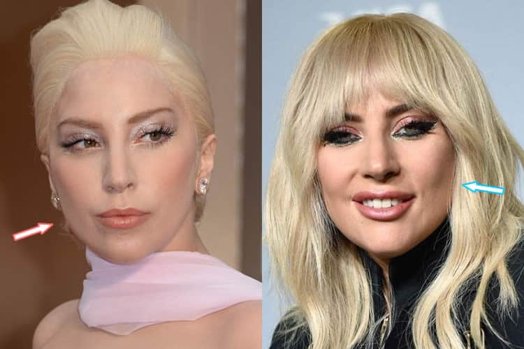 Does Lady Gaga Have Plastic Surgery? (Before & After )