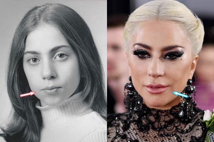 Lady Gaga’s mouth shape changed over the years and it doesn’t look like it’...