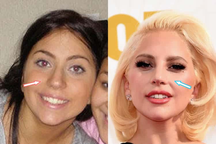 Lady Gaga’s nose tip is a dead give-away that she had rhinoplasty, accordin...