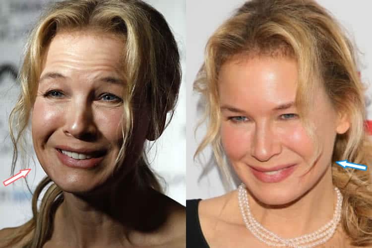 Renee Zellweger Plastic Surgery REVEALED? (Before & After 2018)