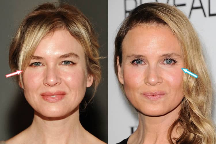 Renee Zellweger Plastic Surgery REVEALED? (Before & After