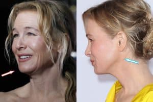 Renee Zellweger Plastic Surgery REVEALED? (Before & After 2018)