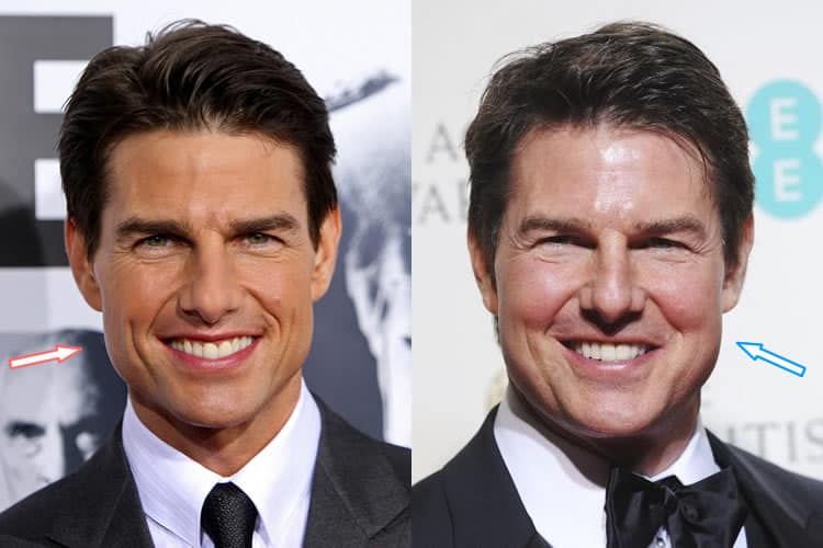 Did Tom Cruise Have Plastic Surgery? (Before & After Photos)