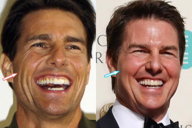 tom-cruise-face-lift.jpg