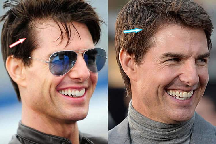 Did Tom Cruise Get Hair Transplant?