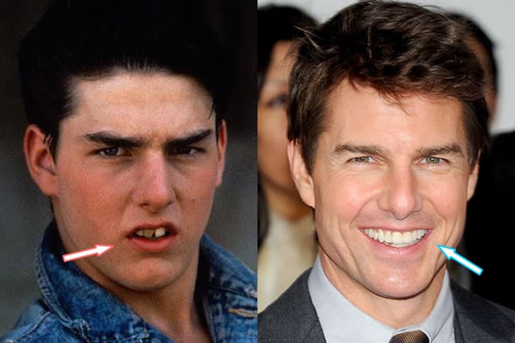 Maybe you would like to learn more about one of these? Tom Cruise Teeth Line - Did Tom Cruise Have Plastic Surgery? (Before & After Photos)