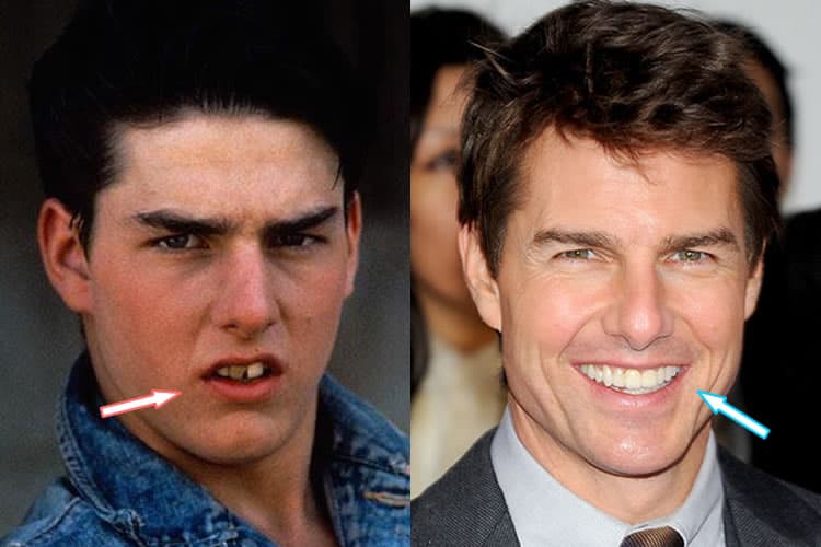 tom cruise old photos teeth