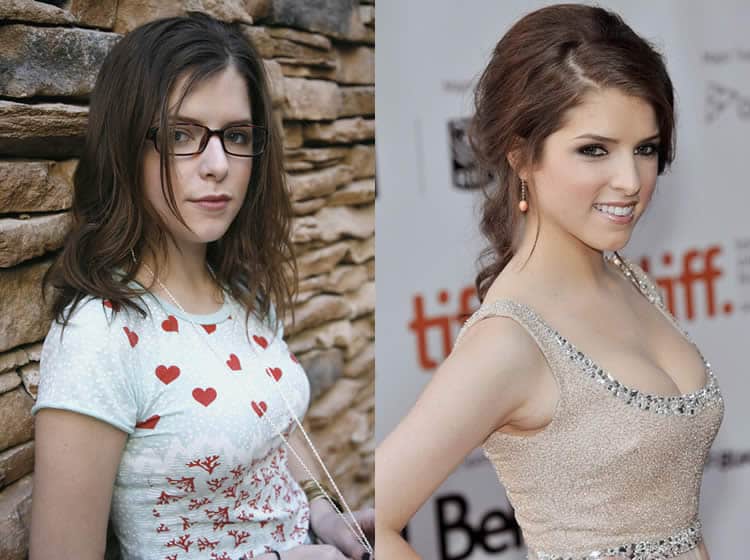 Did Anna Kendrick Get Surgery To Look Hot