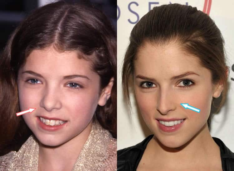 Did Anna Kendrick Have A Nose Job? 