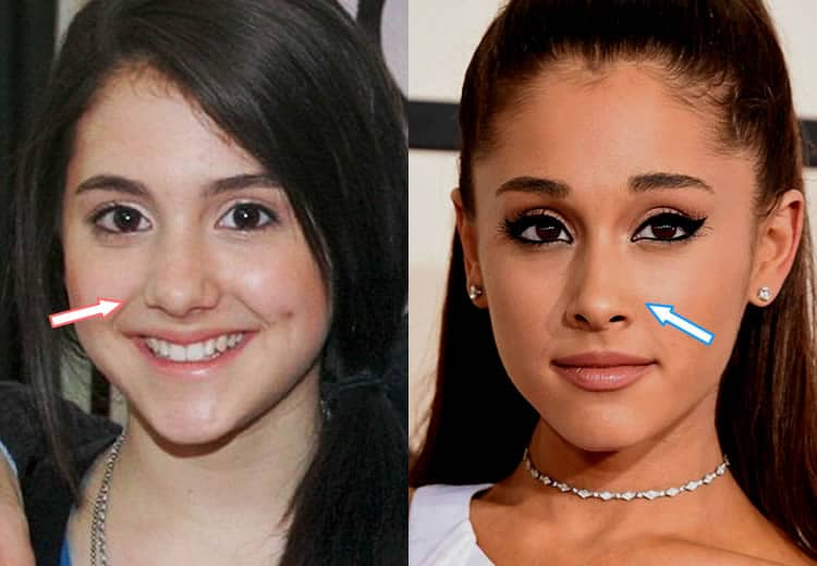 Did Ariana Grande Have Plastic Surgery? (Before & After 2021)