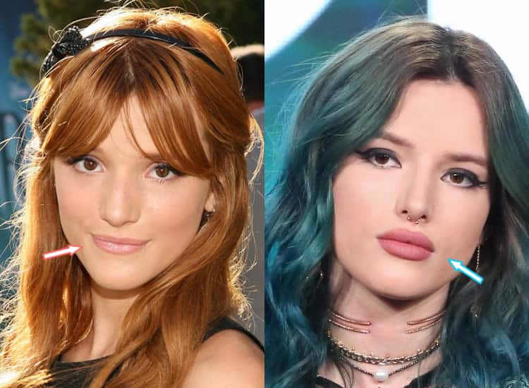 Bella Thorne lip injections before and after photo.