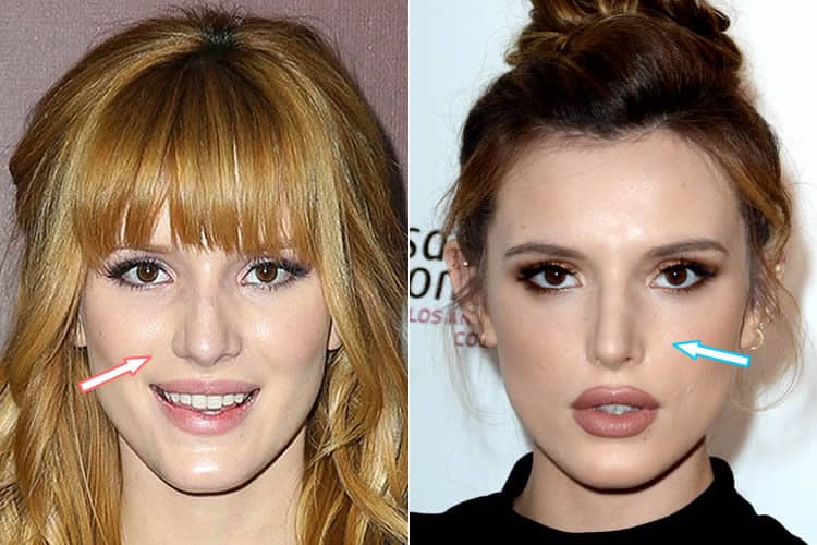 Bella Thorne nose job before and after photo.