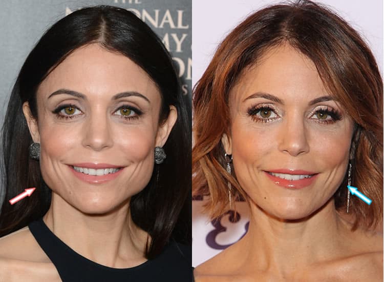 Did Bethenny Frankel Have Jaw Surgery?