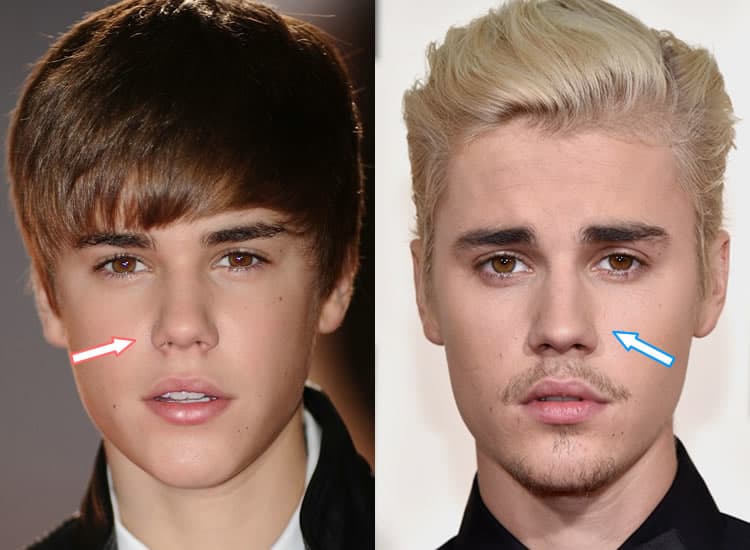Did Justin Bieber Get A Nose Job?