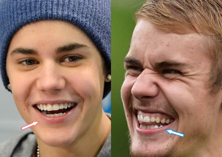 Did Justin Bieber Fix His Bad Teeth?